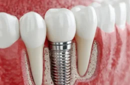 İmplant Tedavisi Nedir? Kimler İçin Uygundur?